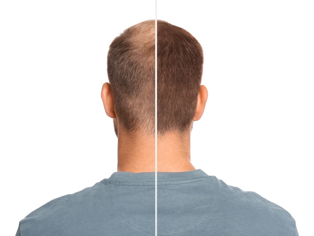 hmb hair loss