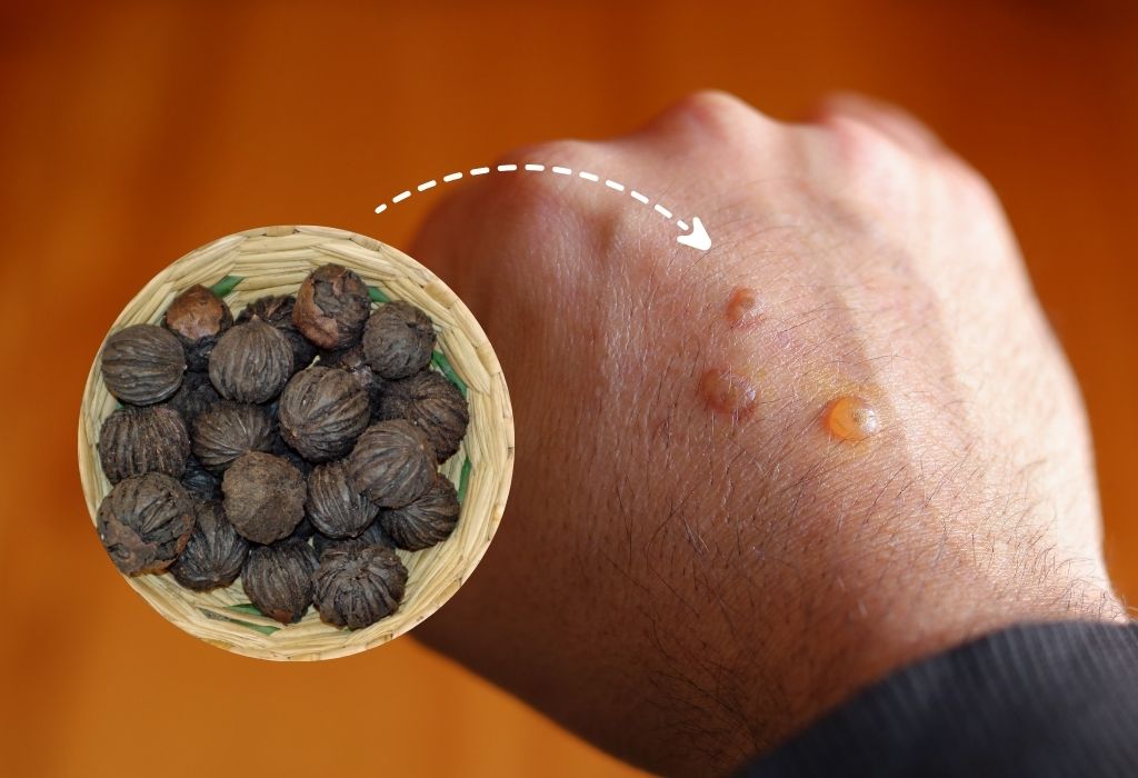 can black walnuts cause blistered hands