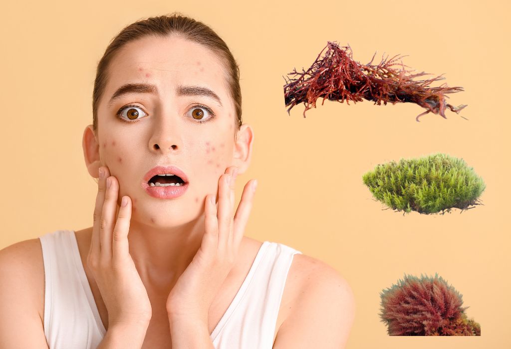 sea moss for acne