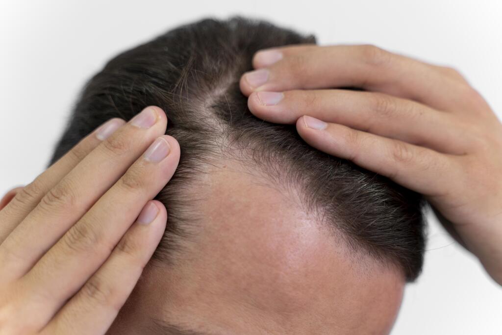 Does Tongkat Ali Cause Baldness